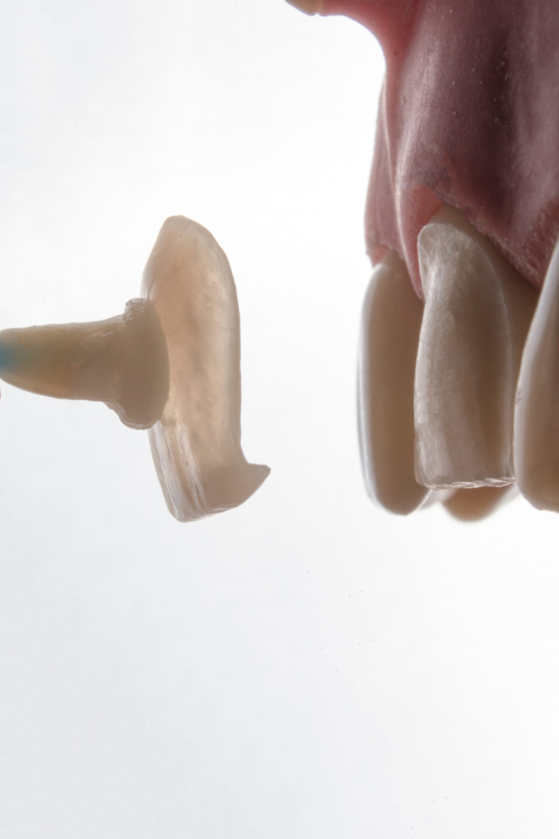 Protesis dentales en Valladolid - Clinica dental Sonrie